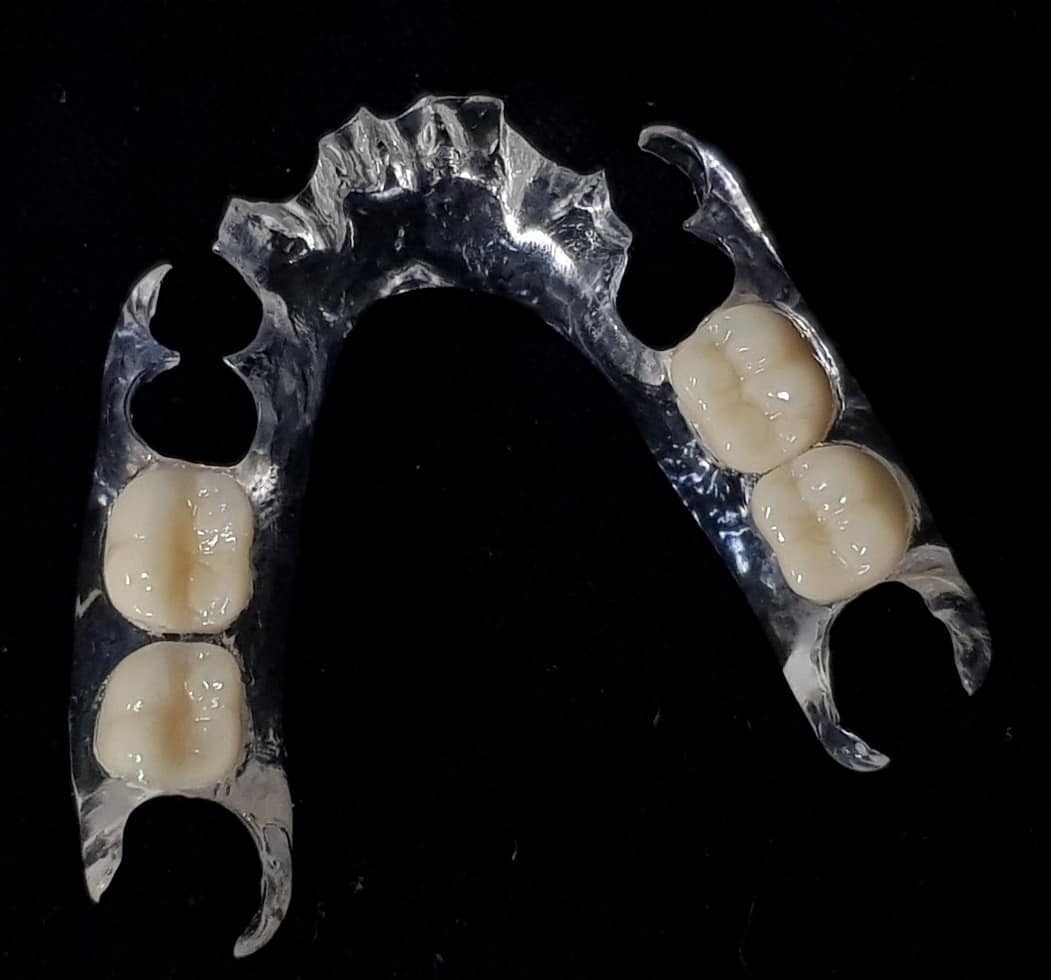 Individuelles Provisorium von S-DENT mit transparenten Klammern